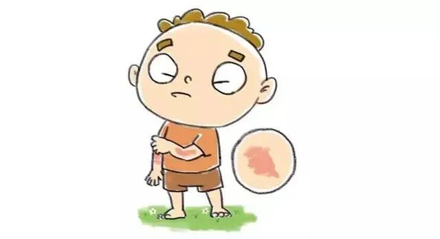 别不把荨麻疹当回事，它的危害你伤不起！